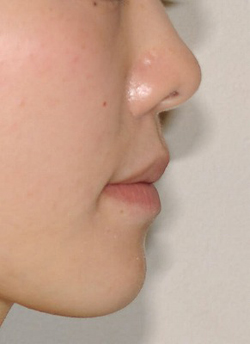 下顎前突（受け口）の矯正治療症例