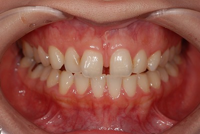空隙歯列（すきっぱ）の矯正治療症例
