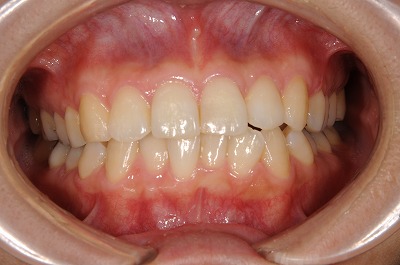 上の前歯が不正（叢生）の矯正治療症例