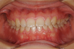 受け口（下顎前突）の矯正治療症例