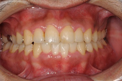 叢生（上下の前歯が不正）の矯正治療症例