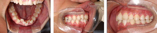 叢生（上下の前歯が不正）の矯正治療症例